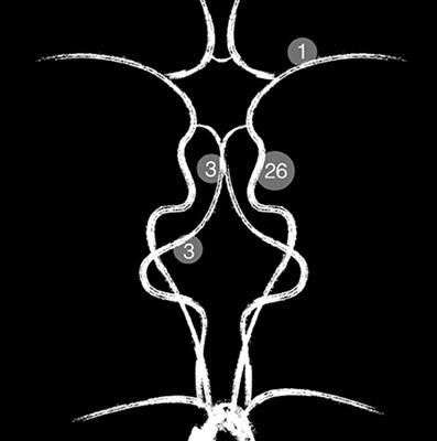 First Experience of Three Neurovascular Centers With the p64MW-HPC, a Low-Profile Flow Diverter Designed for Proximal Cerebral Vessels With Antithrombotic Coating